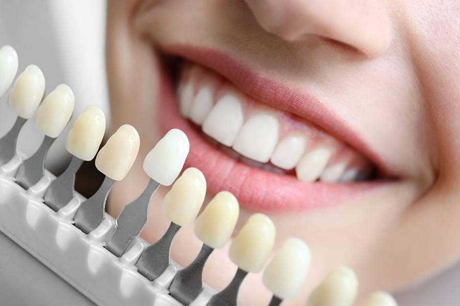 Everything You Need To Know About Teeth Whitening