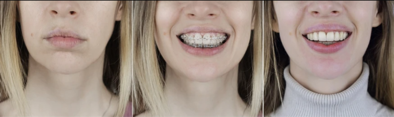 Teeth Whitening After Braces