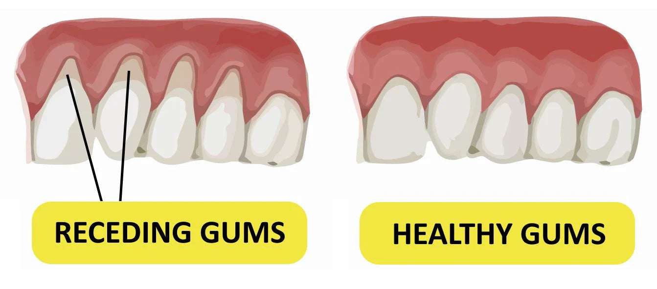 How to Prevent Receding Gums: Essential Tips for Gum Health