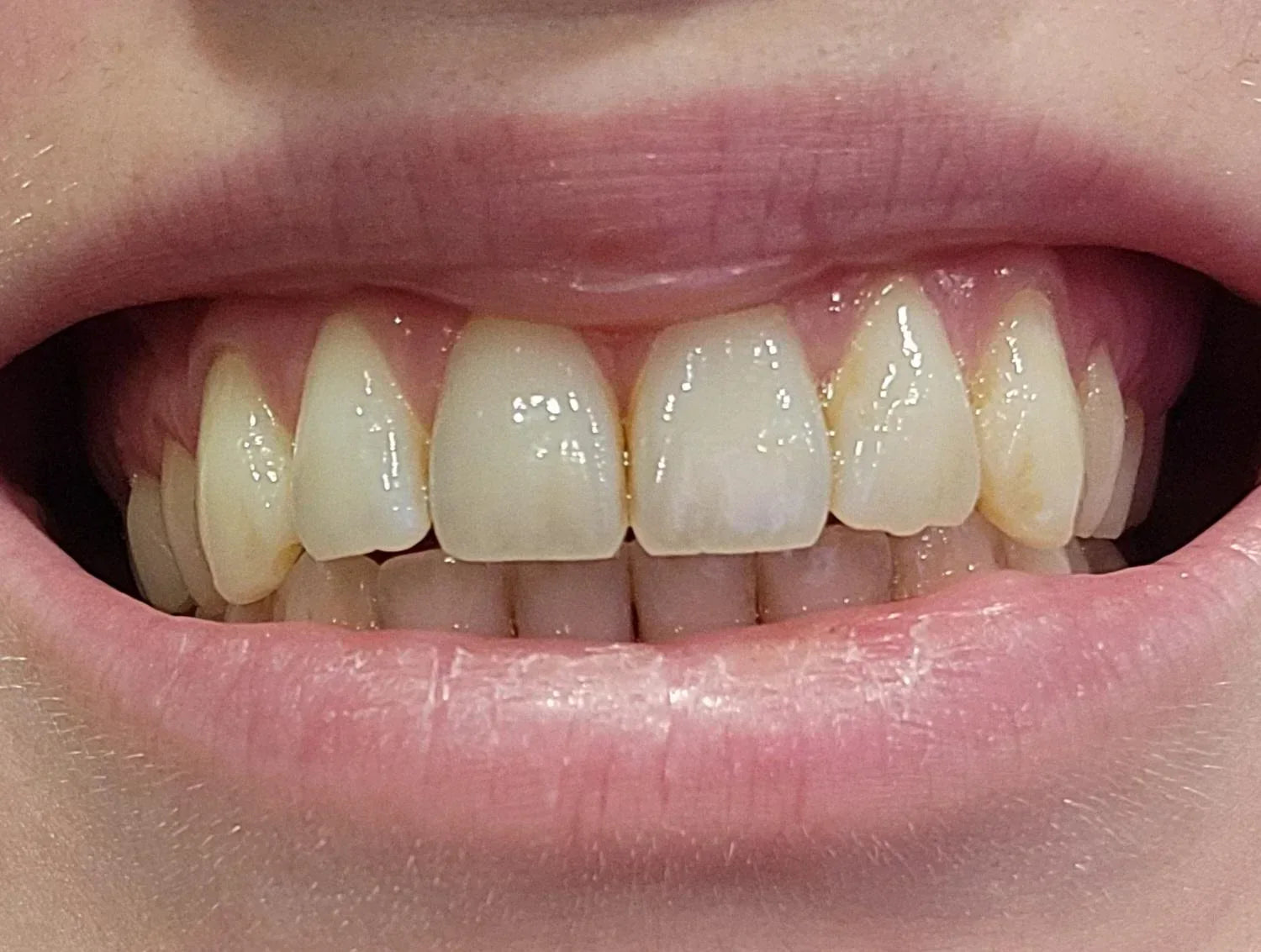 How to Protect Your Enamel If You Suffer from Acid Reflux