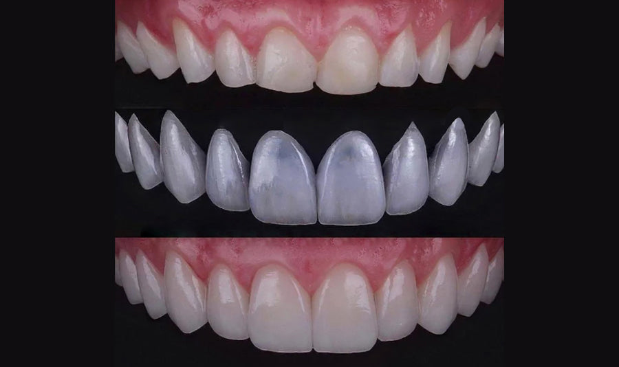 Essential Considerations for Tooth Whitening After Veneers, Crowns and Implants