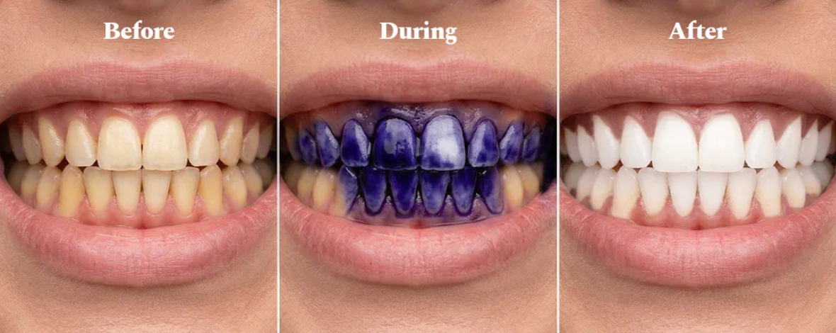 Teeth before application look yellow, during application are coated in purple serum, and after look visibly brighter.
