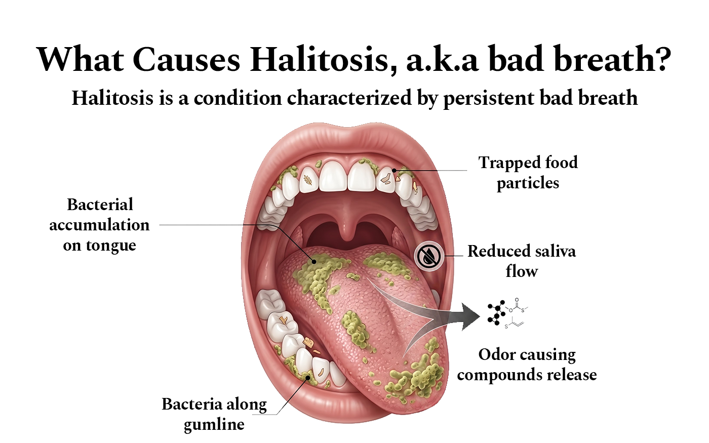 What causes halitosis, a.k.a bad breath: bacterial accumulation on the tongue, bacteria along the gumline, trapped food particles and reduced saliva flow, which together release odour-causing compounds.