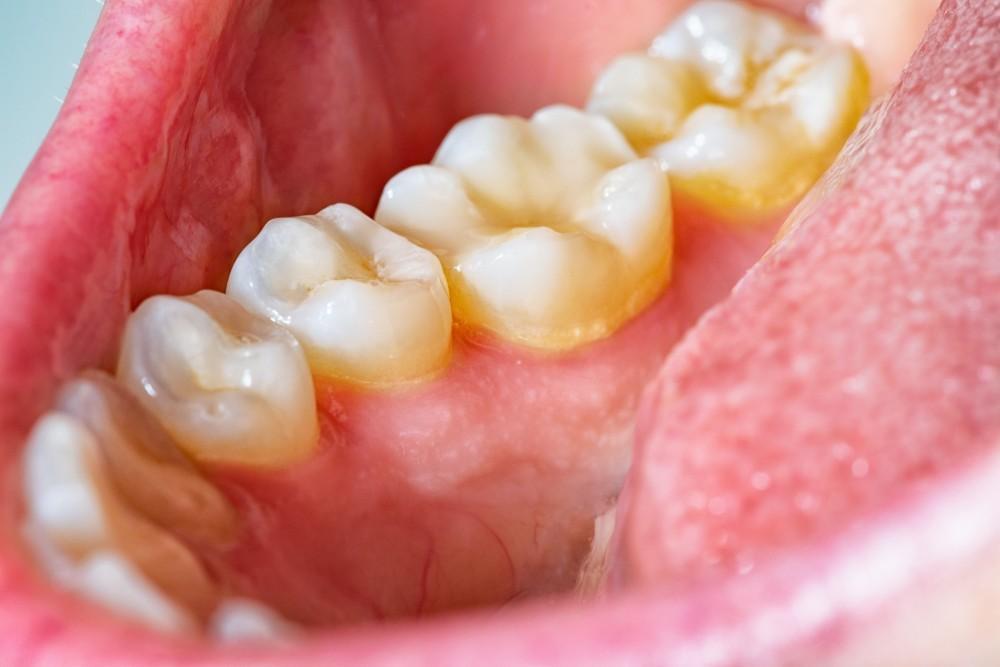 Home remedies for dental plaque