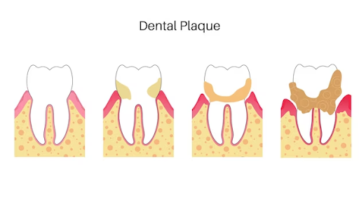 stages of plaque formation.