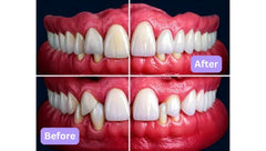 How To Treat Receding Gums