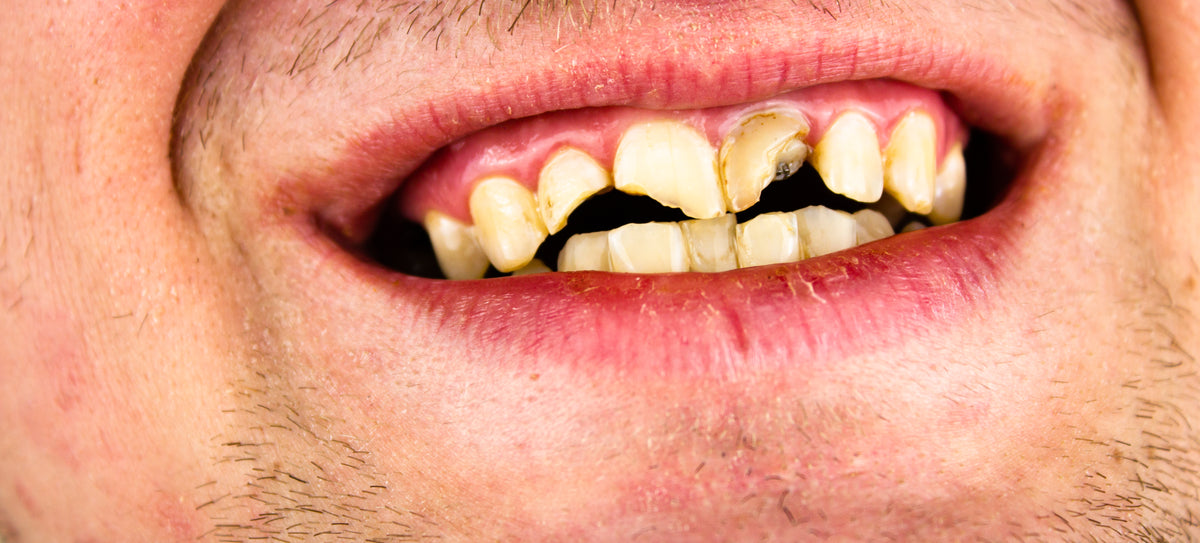 Tooth Person Front Tooth Cavity: Causes and Prevention Tips – Perfora - Oral Care ...
