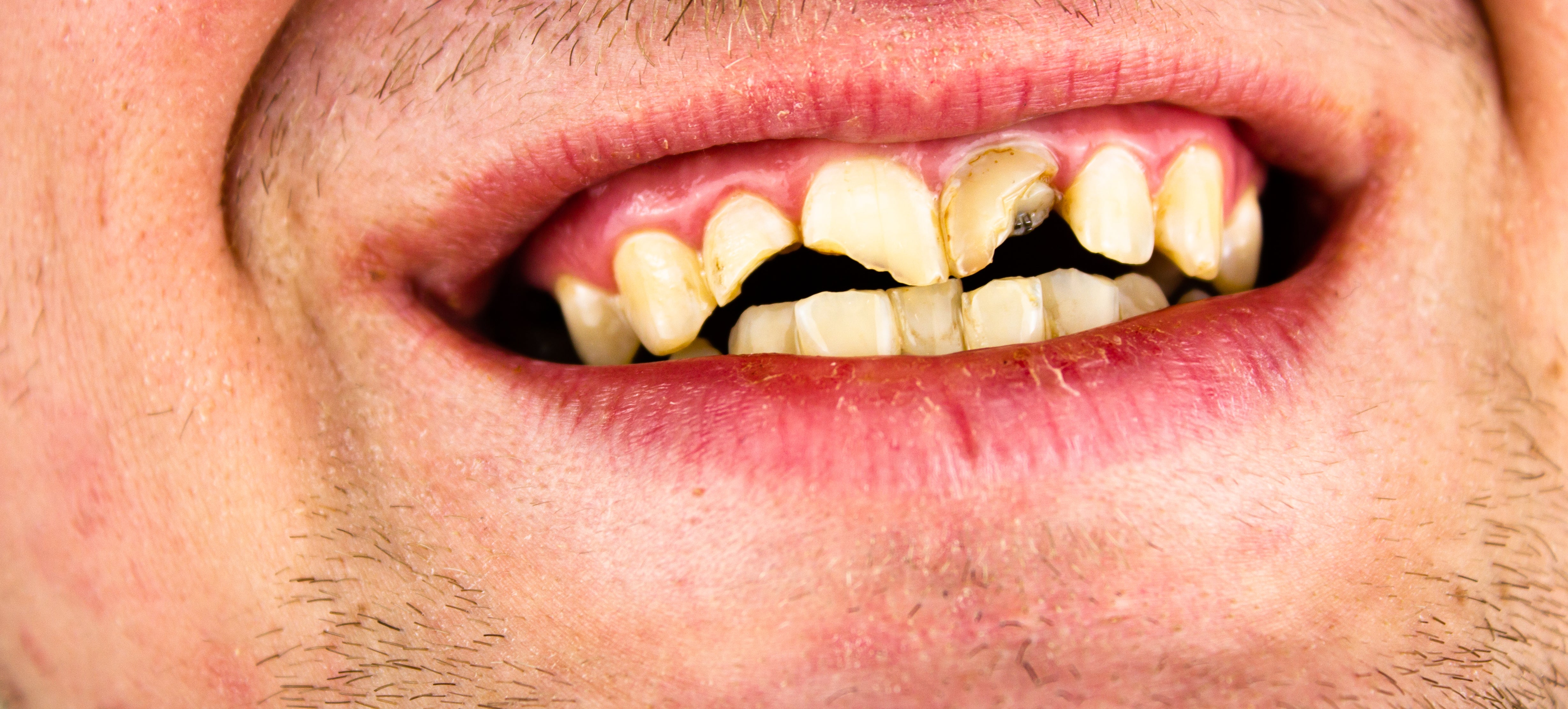 Understanding and Preventing Front Teeth Cavities
