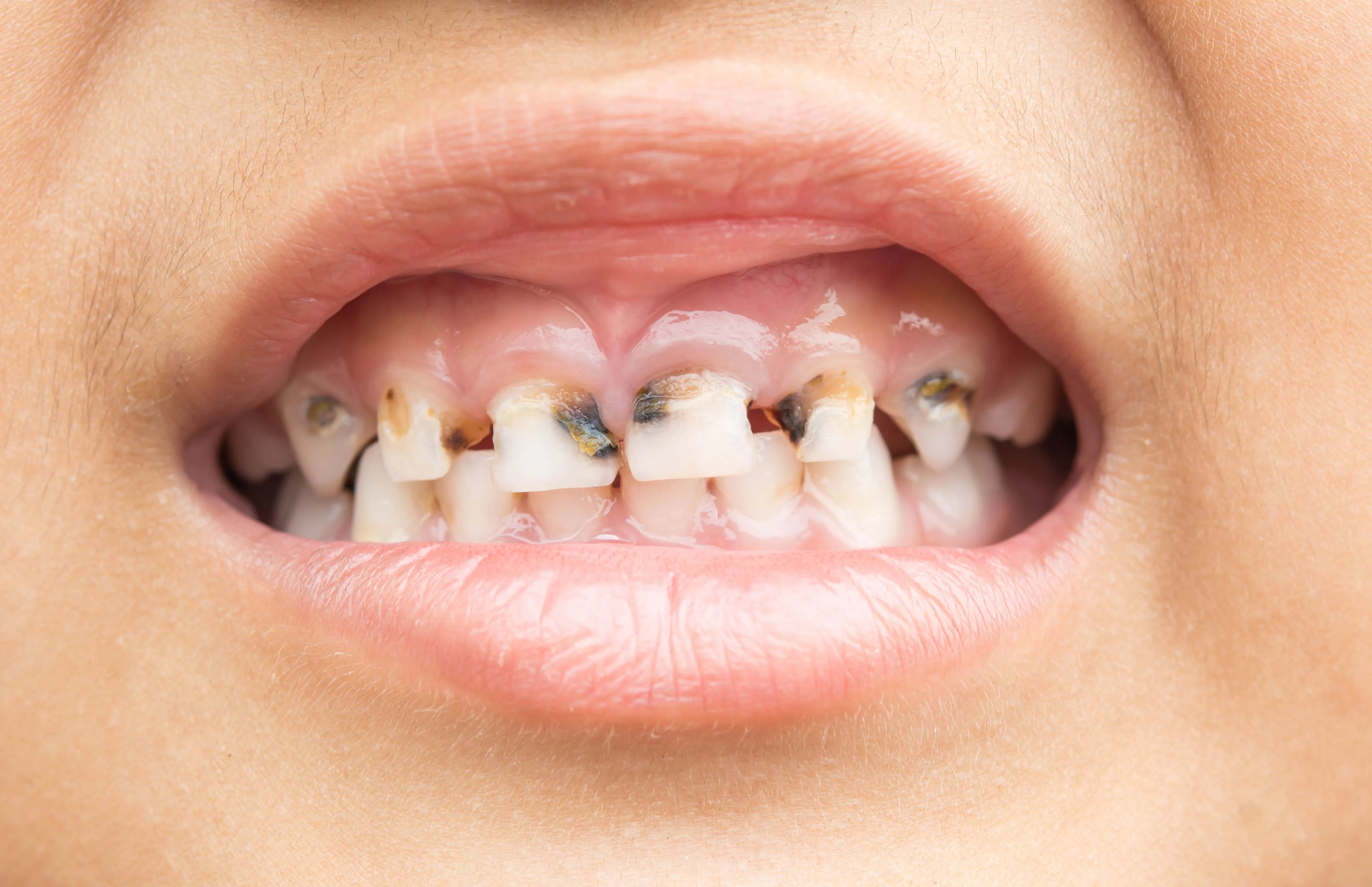 Top Causes of Cavity: What You Need to Know to Protect Your Teeth