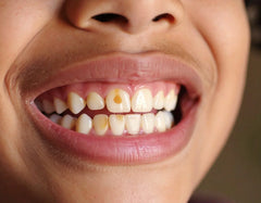 Cavity in Milk Teeth: Should You Treat or Extract?