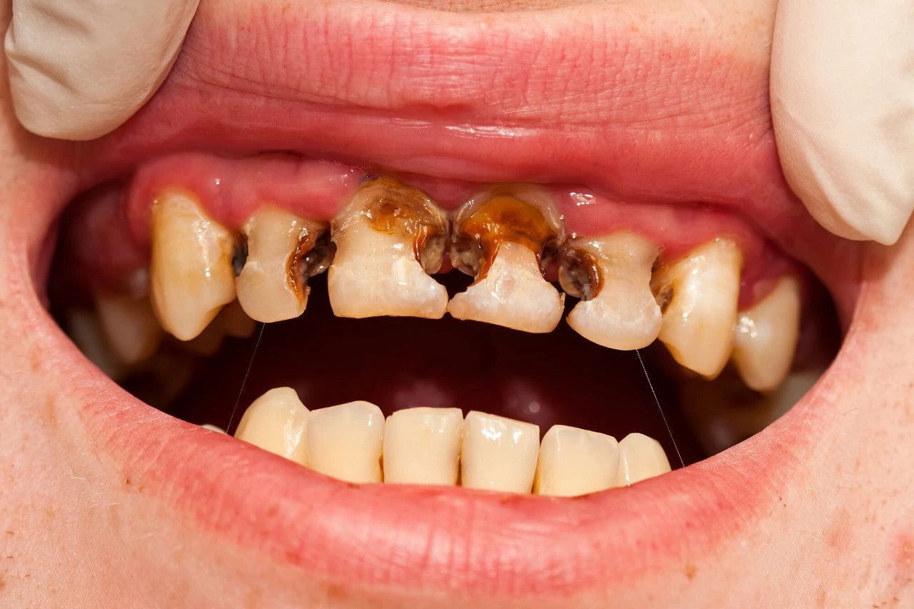 Dangers of Untreated Cavities