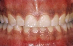 Why Are My Gums Black? Causes, Concerns and When to Seek Help