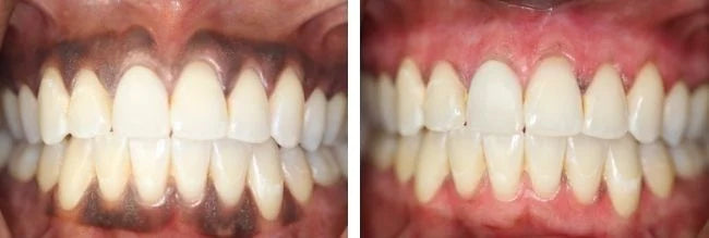 Effective Remedies for Dark Gums: How to Lighten and Restore Gum Health