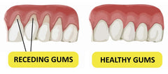 How to Prevent Receding Gums: Essential Tips for Gum Health