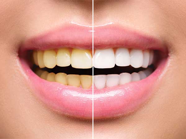Teeth Whitening Tips for whiter teeth: Natural home remedies & products