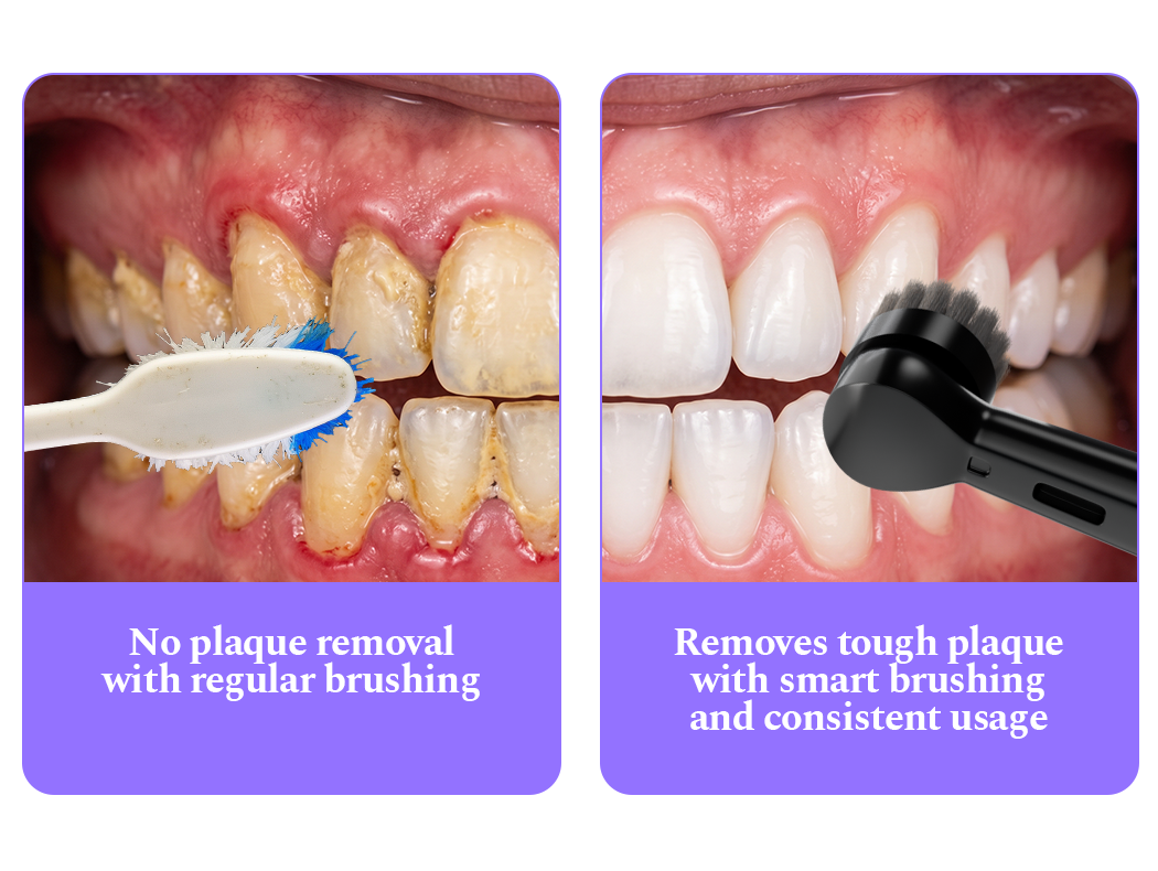 Side by side: no plaque removal with regular brushing versus removing tough plaque with smart brushing and consistent usage.