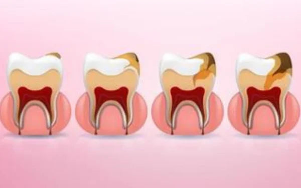 Dental Cavities